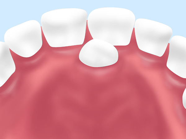 過剰歯（かじょうし）の抜歯