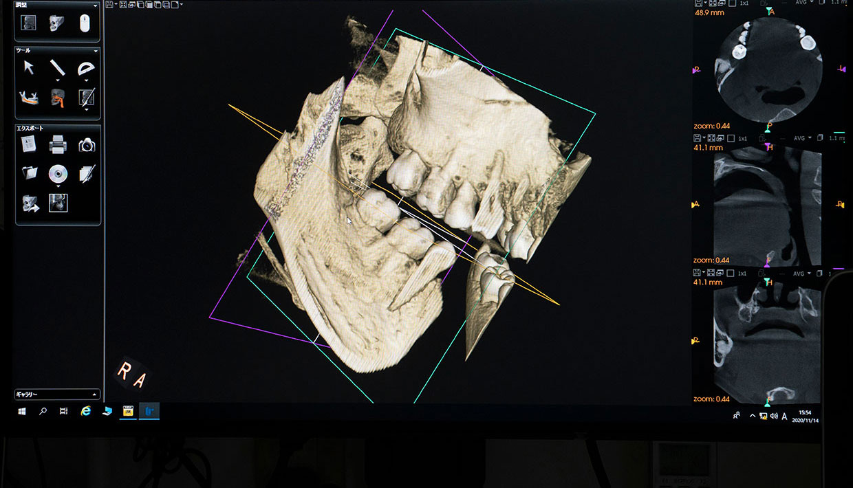 精密な診断ができる歯科用CT ヨシダ社製トロフィーパンプラス