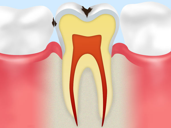 虫歯の進行具合をご存知ですか？