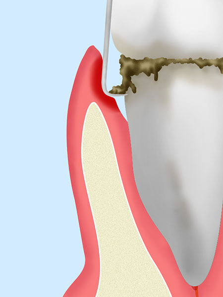 歯周ポケット掻爬(そうは)術