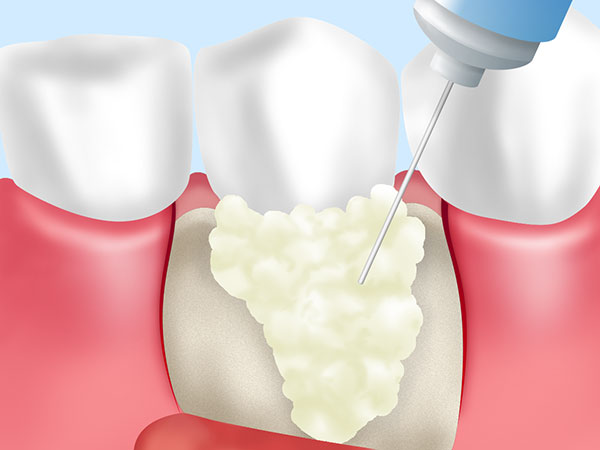 リグロス（歯周組織再生療法）