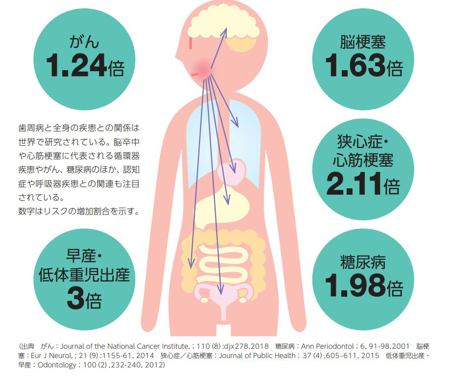 歯周病は体の全体に影響を与える病気です