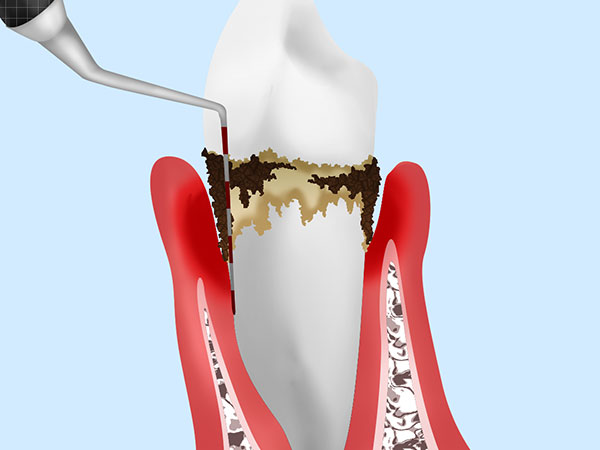 歯周ポケット