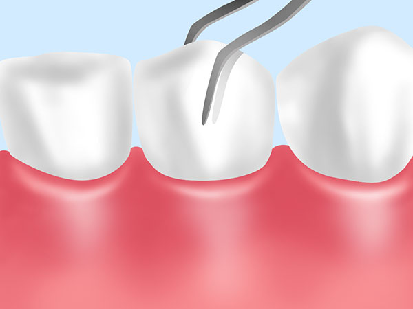 歯の揺度
