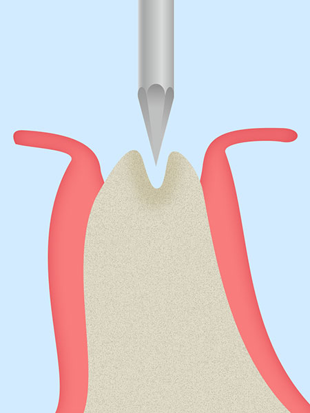 スプリットクレスト（歯槽堤分割術）